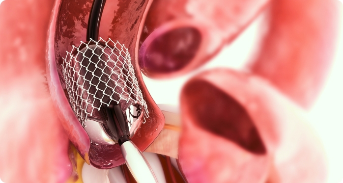 Coronary angiogram procedure in Singapore