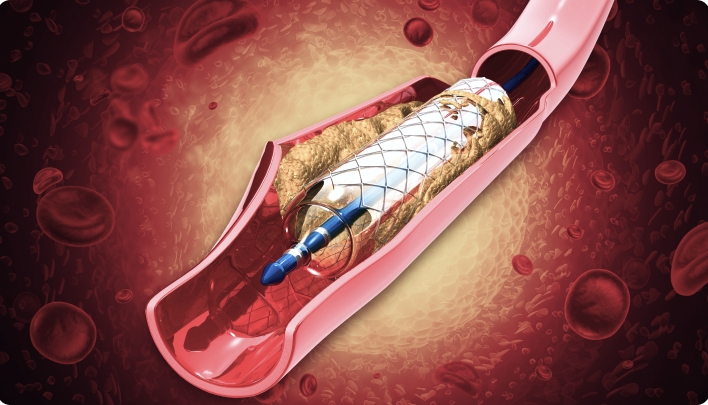 Angioplasty treatment in Singapore