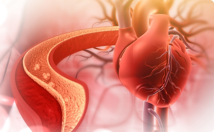 Narrowing coronary arteries