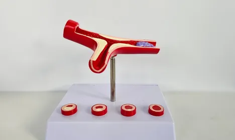 Atherosclerosis vs Arteriosclerosis: What's the Difference